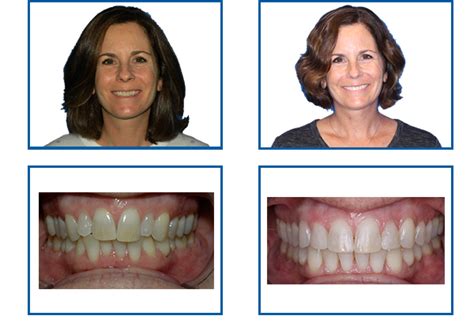 Smile After Braces - Dental News Network