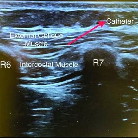 Catheter Placement For Eoi Block Eoi External Oblique Intercostal