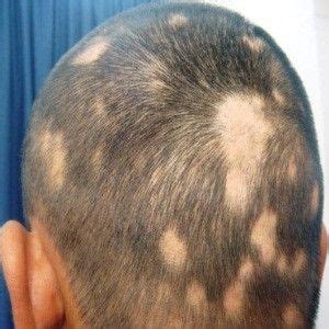 Dark Hair Rinse Patchy Hair Loss Syphilis