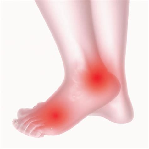 Gout in Your Ankle: Causes, Symptoms, and Treatment Options - The Cognitive Orbit