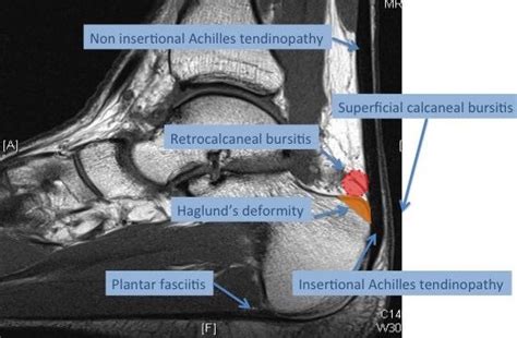 Achilles Anatomy Achilles Tendinosis Treatment Mri Adelaide