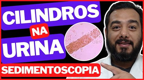 O Que Significa Presen A De Cilindro Na Urina Sedimentoscopia