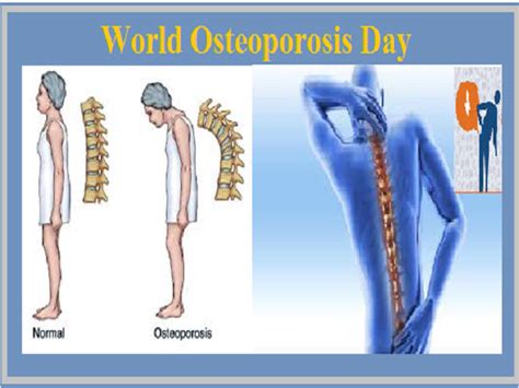 World Osteoporosis Day 2020 History Significance And Facts