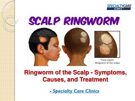 PPT - Ringworm of the Scalp - Symptoms, Causes, and Treatment PowerPoint Presentation - ID:11225480