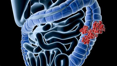 Colorectal Cancer Answers From Surgeon Sandy Fang Johns Hopkins Medicine