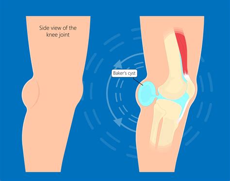 Baker's Cyst - My Family Physio