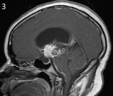 Craniopharyngioma Radiology