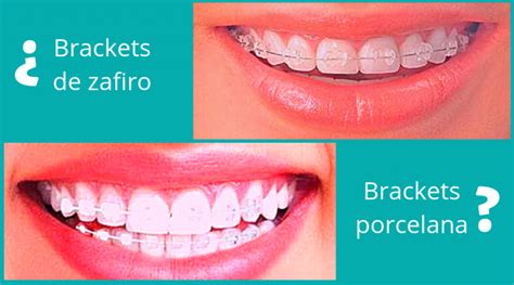 Brackets De Zafiro O Brackets De Porcelana Blog Masquemedicos