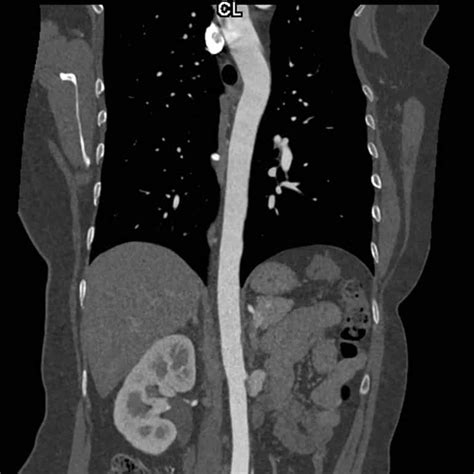 Ultra Low Dose Ct Scan Melbourne Radiology