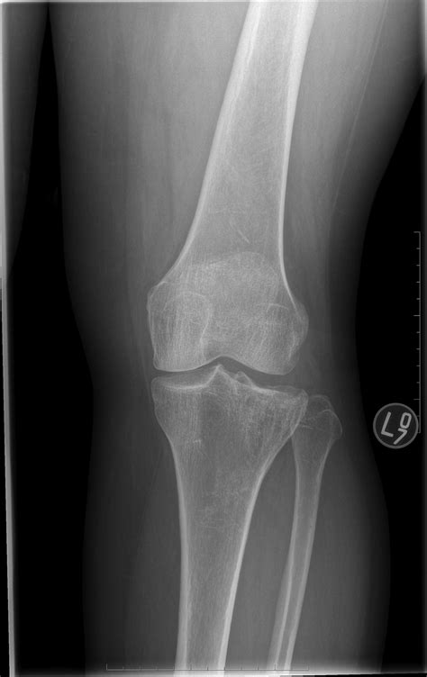 Outcomes of Bulk Fresh Osteochondral Allografts for Cartilag... : JBJS