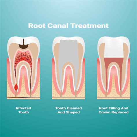 A Complete Guide To Root Canal And Its Treatment