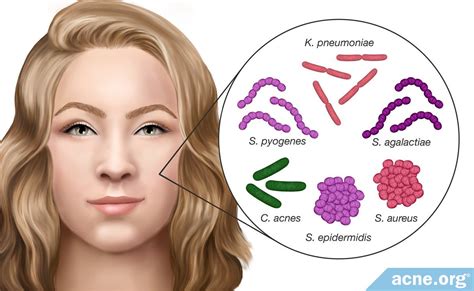 Do Different Strains of Acne Bacteria Affect Acne Differently? - Acne.org