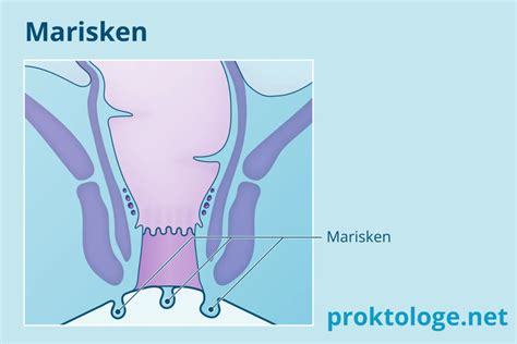 Marisken Proktologe Prof Dr Med Edgar Hancke