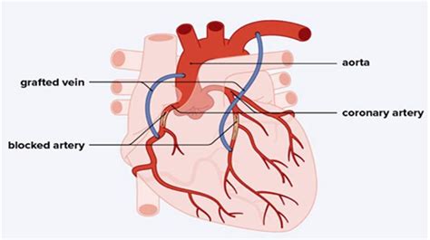 Heart Bypass Surgery in India: Causes, Procedure, Hospitals