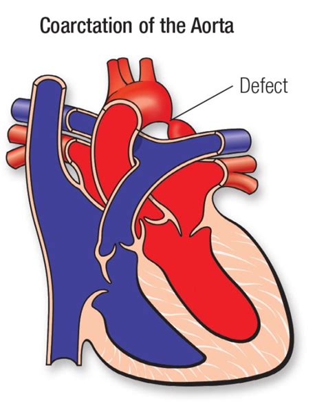 Symptoms Of Coarctation Of The Aorta