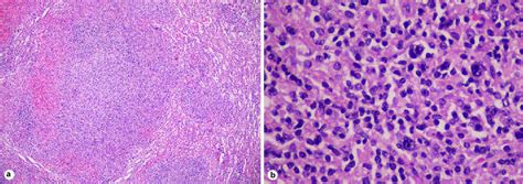 Figure 1 From Splenic Micronodular T Cell Histiocyte Rich Large B Cell Lymphoma Semantic Scholar