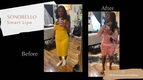 Sono Bello: Before and After - The Smart Lipo Journey