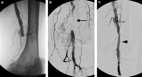 Recanalization Of A Chronically Occluded Popliteal Artery Aneurysm