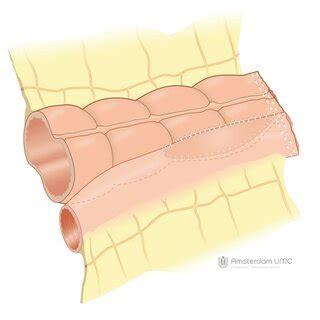 Anisoperistaltic side-to-side anastomosis; A1 = cross stapled line ...