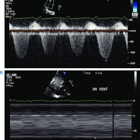 Tricuspid Regurgitation Doppler And Inferior Vena Cava M Mode Imaging