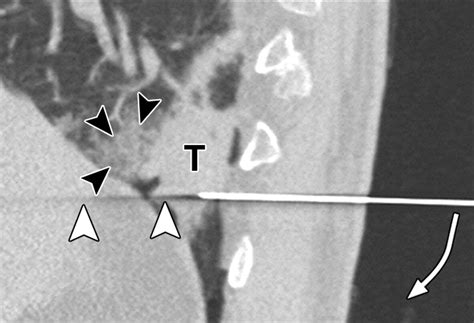 Ct Guided Core Biopsy Of Lung Lesions A Primer Ajr