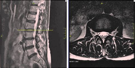 Hernie De Disc Fizioterapie I Kinetoterapie Ia I Topkineto Topkineto