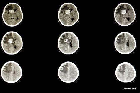 9 Essential Cerebral Edema Treatment Guidelines