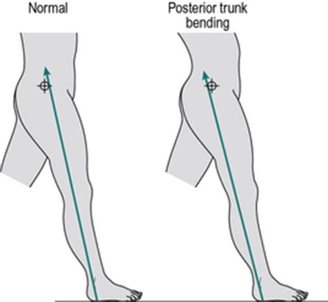 Gait Deviations Hip Pelvis Trunks Flashcards Quizlet