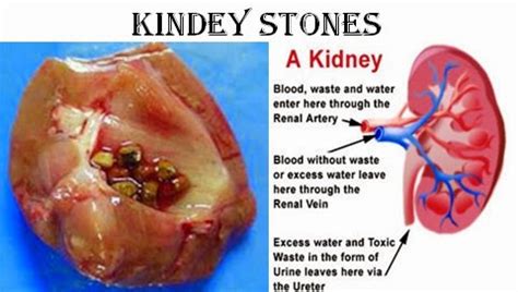 Diet To Rid Uric Acid Kidney Stones - decoposts