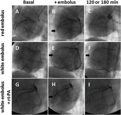 Coronary embolism changes at different time points were revealed by ...