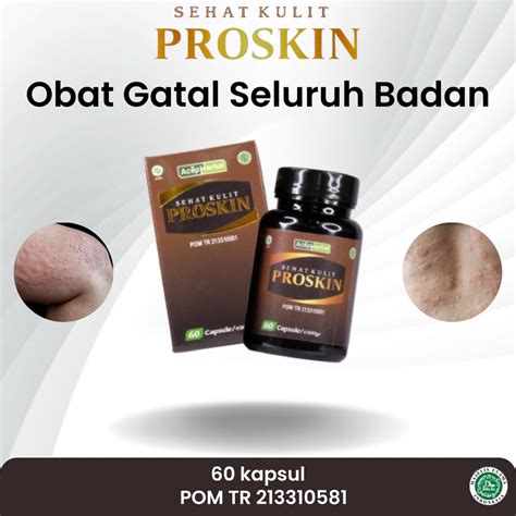 Jual Obat Gatal Seluruh Badan Korengan Budug Bernanah Gatal