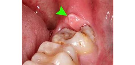 Siso Inflamado Pericoronarite O Que Devo Fazer
