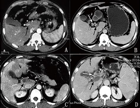 Figure 1 From Rational Classification Of Portal Vein Thrombosis And Its