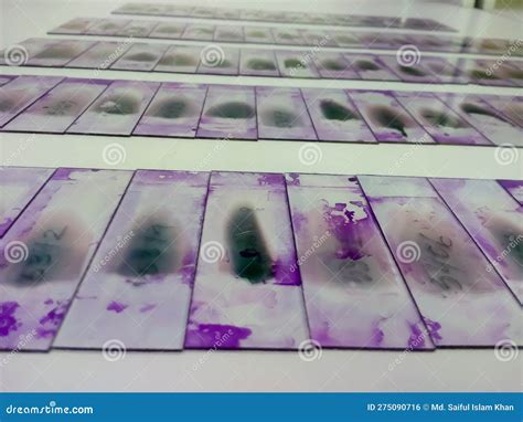 Stained Glass Slides Of Peripheral Blood Smear With Violet Leishman