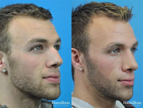 Rhinoplasty Before And After Gallery Patient 10