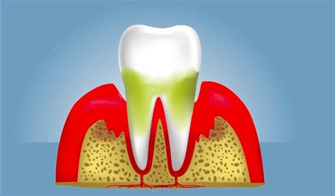 Musc Research Suggests Statins May Help Fight Gum Disease Musc Charleston Sc