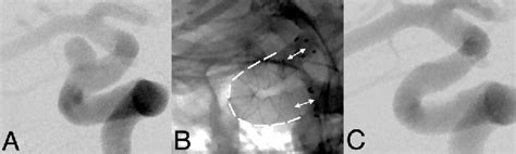 Figure 2 From The FRED Flow Diverter Stent For Intracranial Aneurysms