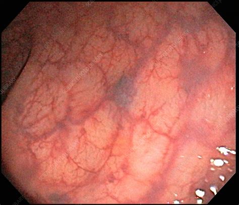 Angiodysplasia Of The Colon As Related To Sulfasalazine Pictures