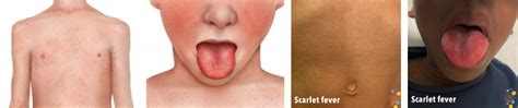 Strep A And Scarlet Fever Healthier Together