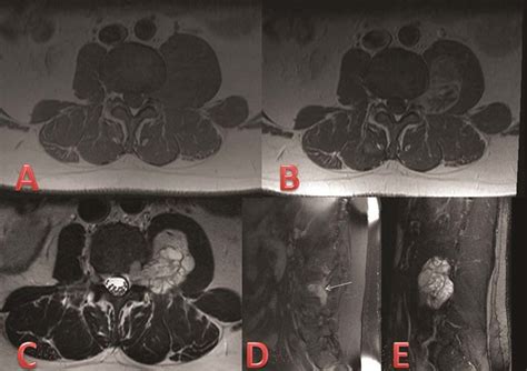 Pre Operative Mri A Axial T1 Mr Sequence Through The L3 4 Level Download Scientific Diagram