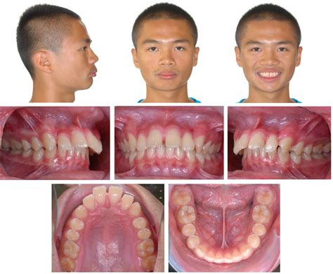 Class Ii Malocclusion With Severe Overjet Treated With Maxillary Second Molar Extractions And