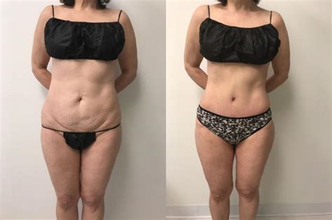 Tummy Tuck Before And After Photo Gallery Barrington Illinois