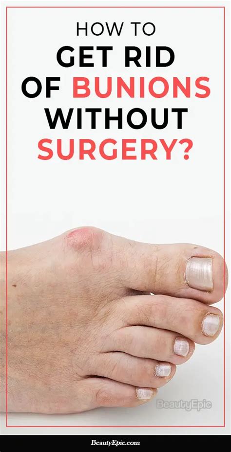 How To Get Rid Of Bunions Without Surgery