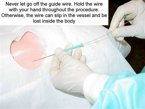 Clinical Notes Central Line Placement A Step By Step Procedure Guide With Photos