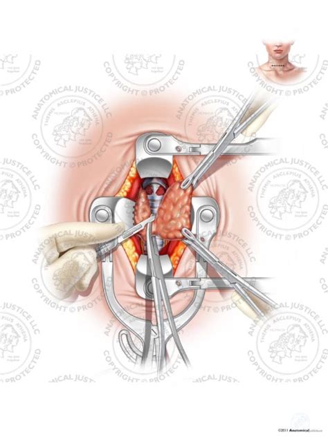 Female Left Thyroid Lobectomy - No Text