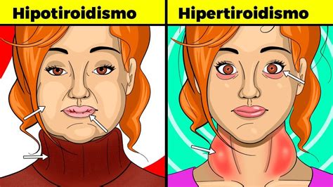 Hipotiroidismo E Hipertioidismo Hipertiroidismo Tiroides Images Porn