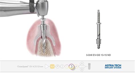 Astra Tech Implant System Ev Guided Surgery Youtube