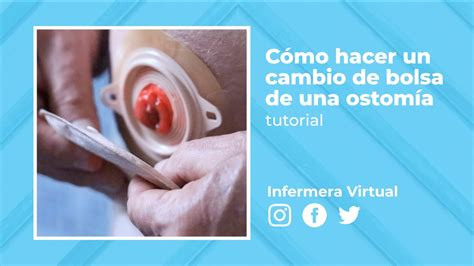 tutorial Cómo hacer un cambio de bolsa de una ostomía YouTube