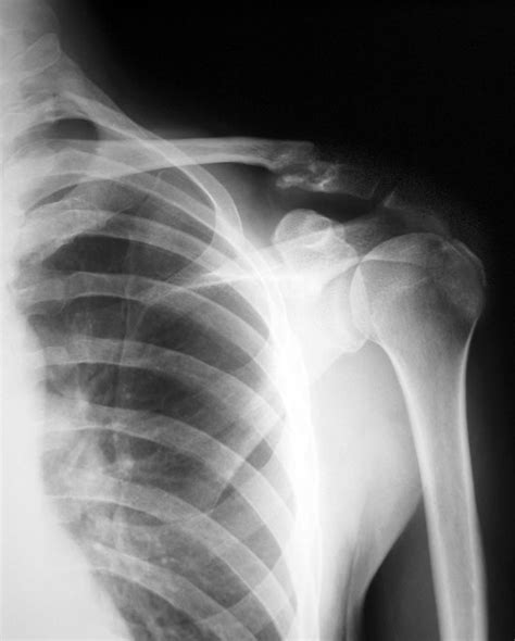 Left Shoulder Xray Hans Kellner Dot Com