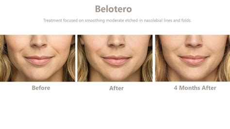 The filler Belotero. Its benefits and the risks - Healthynewage.com